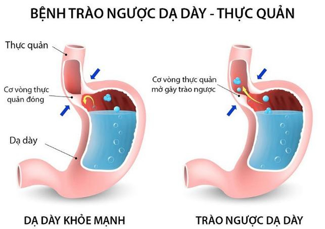 5 tác dụng phụ bất ngờ của bơ đậu phộng, okviphoatdong để tránh rủi ro - Ảnh 1
