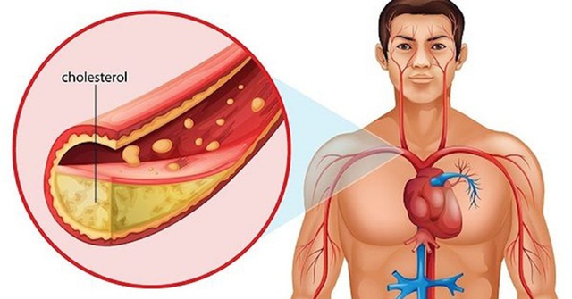 Sự thật về loại chất béo xấu nhất có trong nhiều món ăn ngon nhưng gây hại cho cơ thể - Ảnh 2